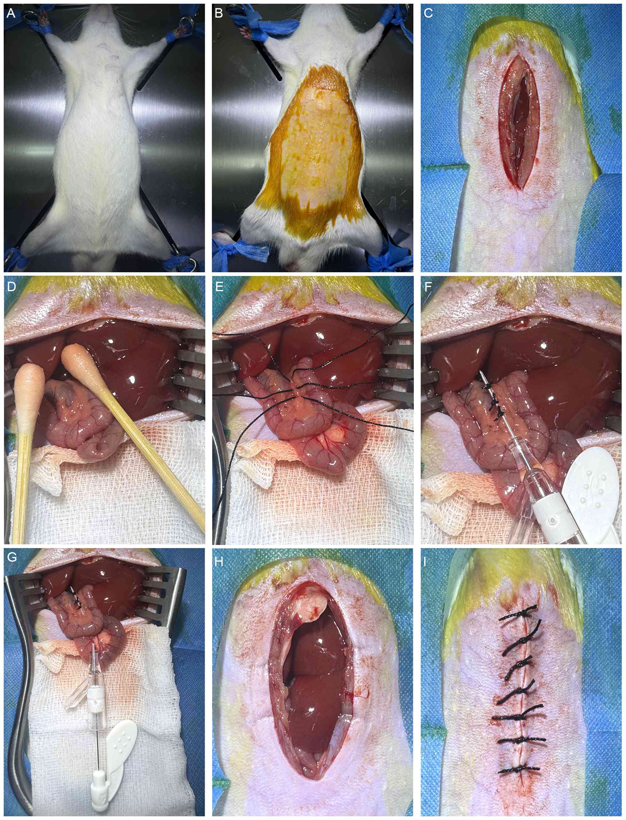 Representative images of the partial
common bile duct ligation procedure. (A) Rat bound in a supine
position; (B) skin preparation and disinfection; (C) opening of the
abdominal cavity; (D) exposure of the bile duct; (E) insertion of
the surgical sutures; (F) binding the trocar; (G) pulling out the
needle core and cutting off the cannula; (H) pushing the intestine
back into the abdomen; (I) closing the abdomen layer by layer.