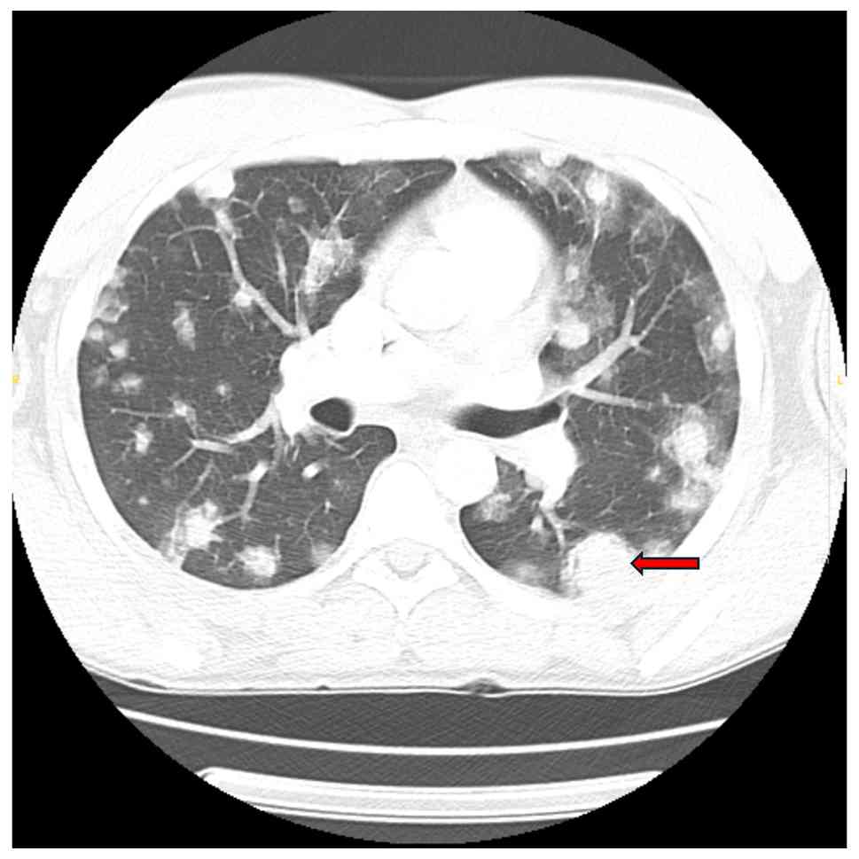 Chest computed tomography scan (day
1), illustrating bilateral pulmonary nodules with surrounding
ground-glass halos, largest measuring 29x24 mm in the left lower
lobe (red arrow).