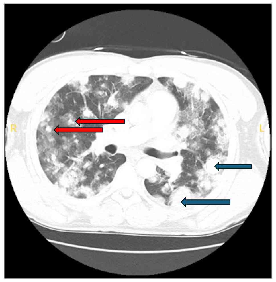 Chest computed tomography scan (day
14) illustrating the increased size and number of nodules.
Bilateral pulmonary nodules are indicated by blue arrows, and
pulmonary masses with surrounding ground-glass opacity are
indicated by red arrows.
