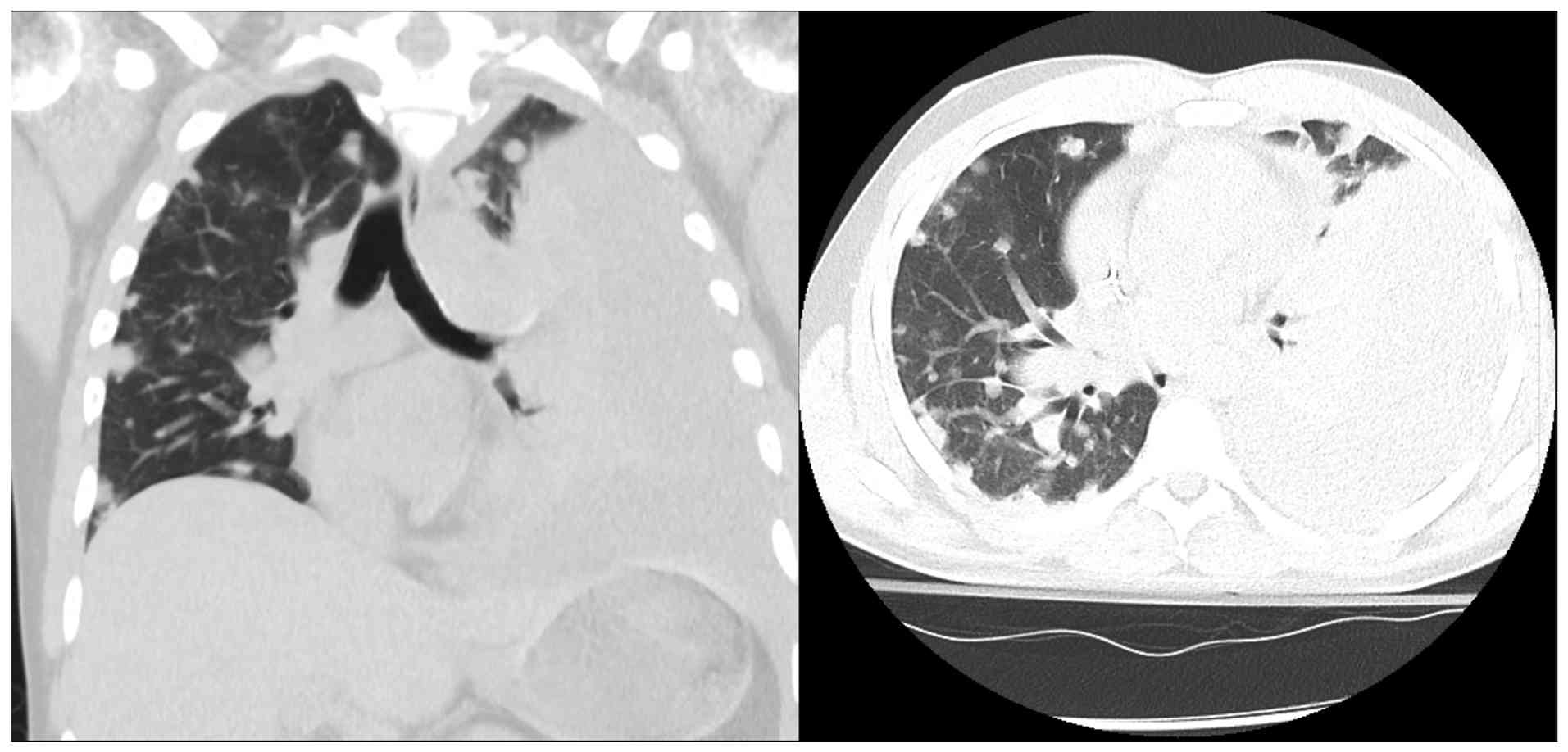 Coronal (left panel) and axial (right
panel) non-contrast chest computed tomography scan (day 45)
illustrating large left pleural effusion with near-complete lung
collapse.