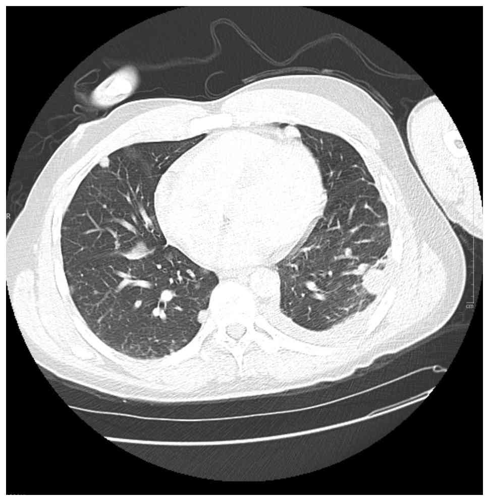 Non-contrast chest computed tomography
scan (day 70) illustrating an improvement in the size and number of
nodules following doxorubicin treatment.