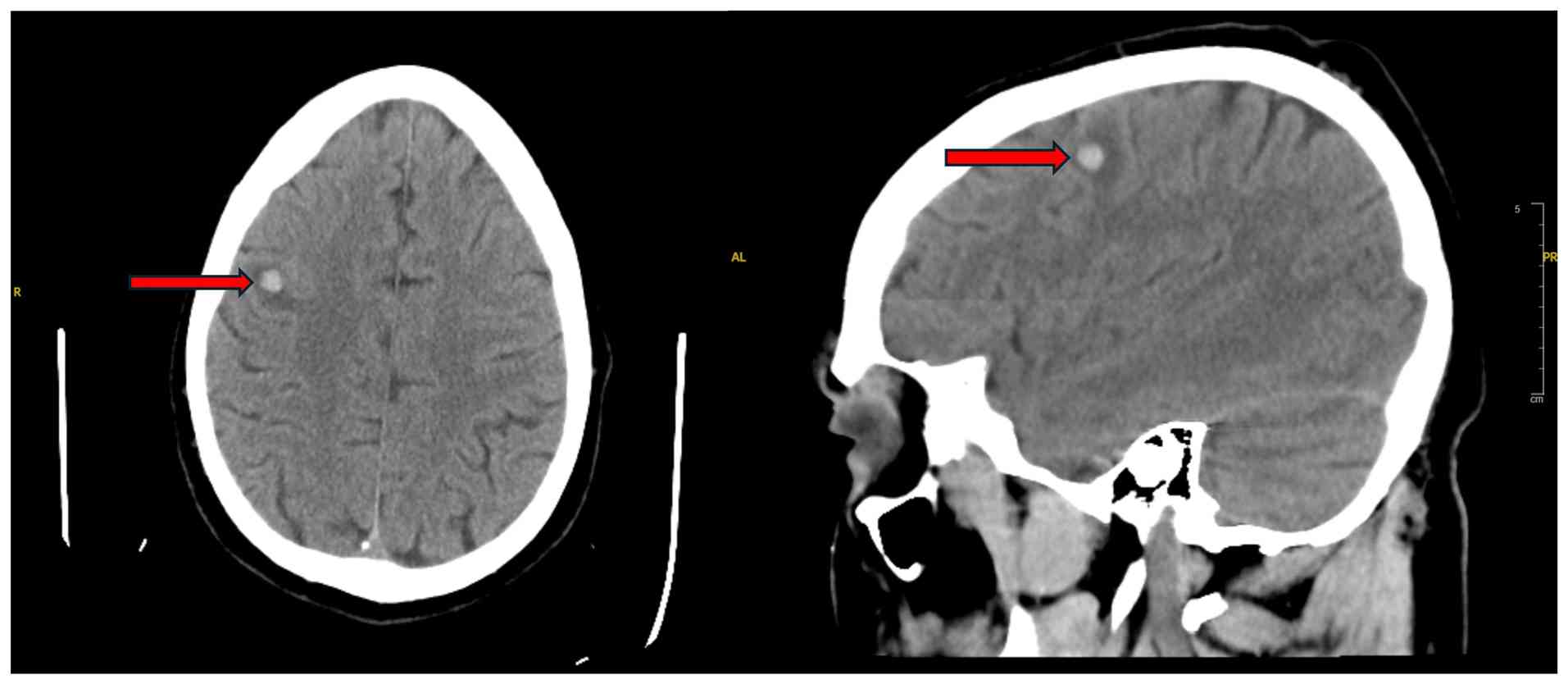 Axial (left panel) and sagittal (right
panel) non-contrast head computed tomography scan (day 106)
illustrating an 8-mm right frontal hemorrhagic metastasis with
surrounding edema.