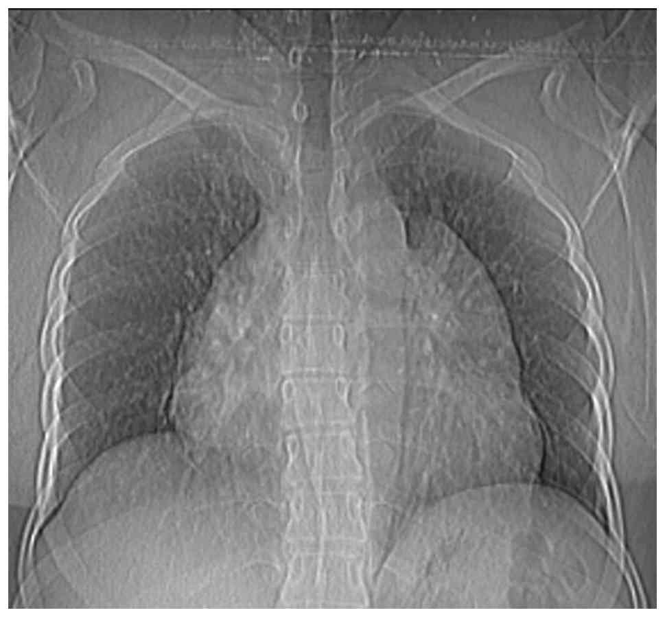 Chest X-ray illustrating an enlarged
mediastinum.