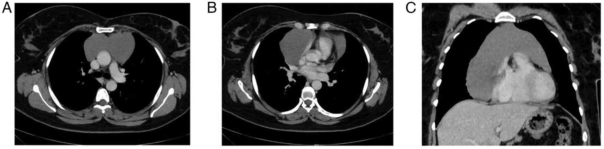 A contrast-enhanced chest computed
tomography scan illustrating the following: (A) A large,
thin-walled cystic lesion in the anterior mediastinum. (B) The cyst
extending into both the right and left sides of the mediastinum,
with a greater extension towards the right. (C) On the right side,
the cyst extends further down to the level of the diaphragm.