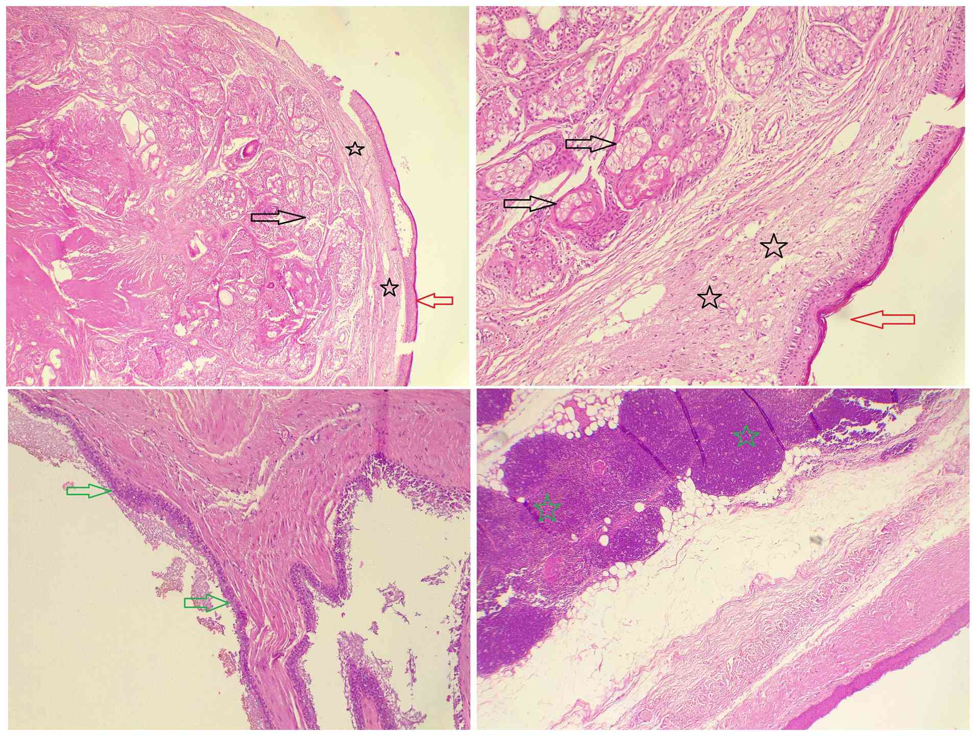 Multiple hematoxylin and eosin-stained
sections, demonstrating two types of epithelial cell lining,
stratified squamous epithelial cells (red arrows) and ciliated
columnar epithelial cells (green arrows), with the presence of
glial tissue (black stars) and sebaceous glands (black arrows),
with unremarkable thymic tissue (green stars) surrounded by adipose
tissue.