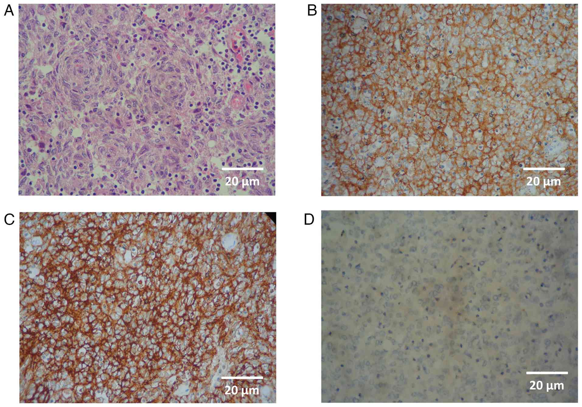 Histopathological analysis with
immunohistochemistry (all images are shown at x400 magnification
with corresponding scale bars at bottom right). (A) Haematoxylin
and eosin staining illustrating a whorled pattern of dendritic
cells with scattered lymphocytes. (B) Staining for CD21
illustrating strong reactivity. (C) Staining for CD23. (D) Weak
staining for leukocyte common antigen (CD45).