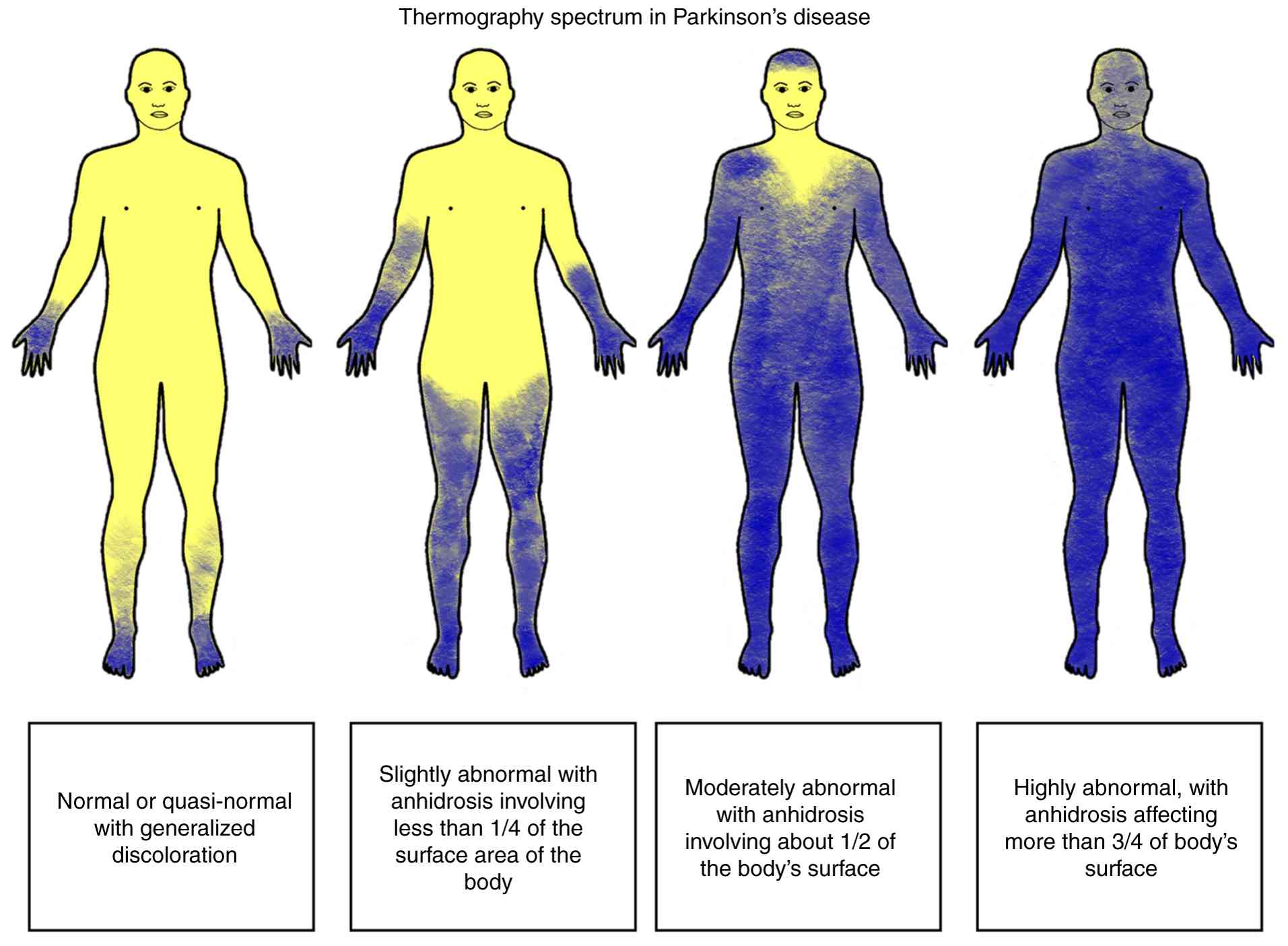 Thermography spectrum in Parkinson's
disease. Anhidrosis pattern on thermoregulatory sweat test noticed
in Parkinson's disease, by Saito et al (319). The pharmacological sweating test is
induced by intradermal injection of acetylcholine, and a
capacitance hygrometer is used to quantitatively measure the
sweating.
