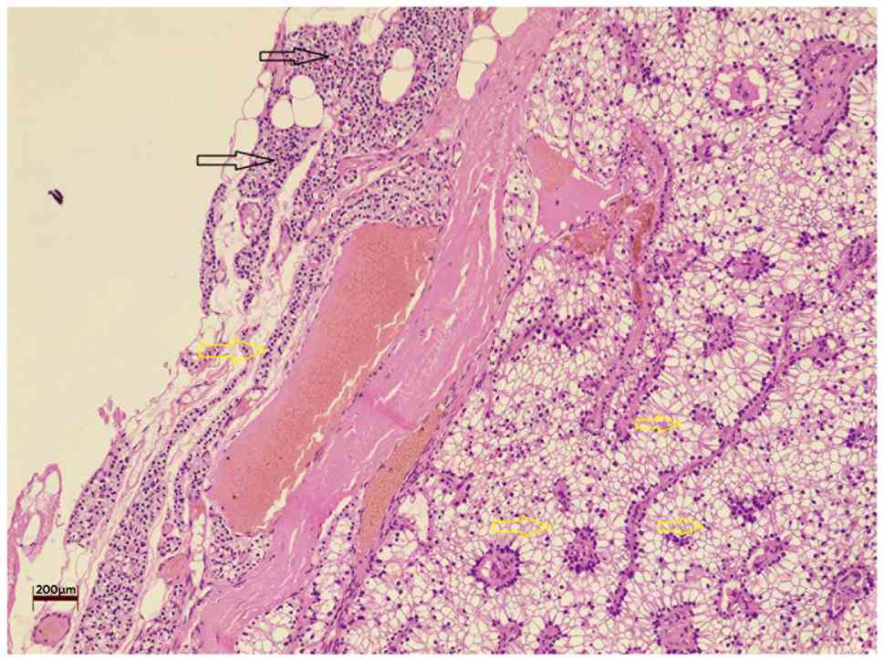 Section illustrating a
well-circumscribed mass composed of cells with uniform nuclei and
clear cytoplasm (yellow arrows), adjacent to a small, unremarkable
area of normal parathyroid tissue (black arrows). Hematoxylin and
eosin staining; magnification, x10; scale bar, 200 µm.
