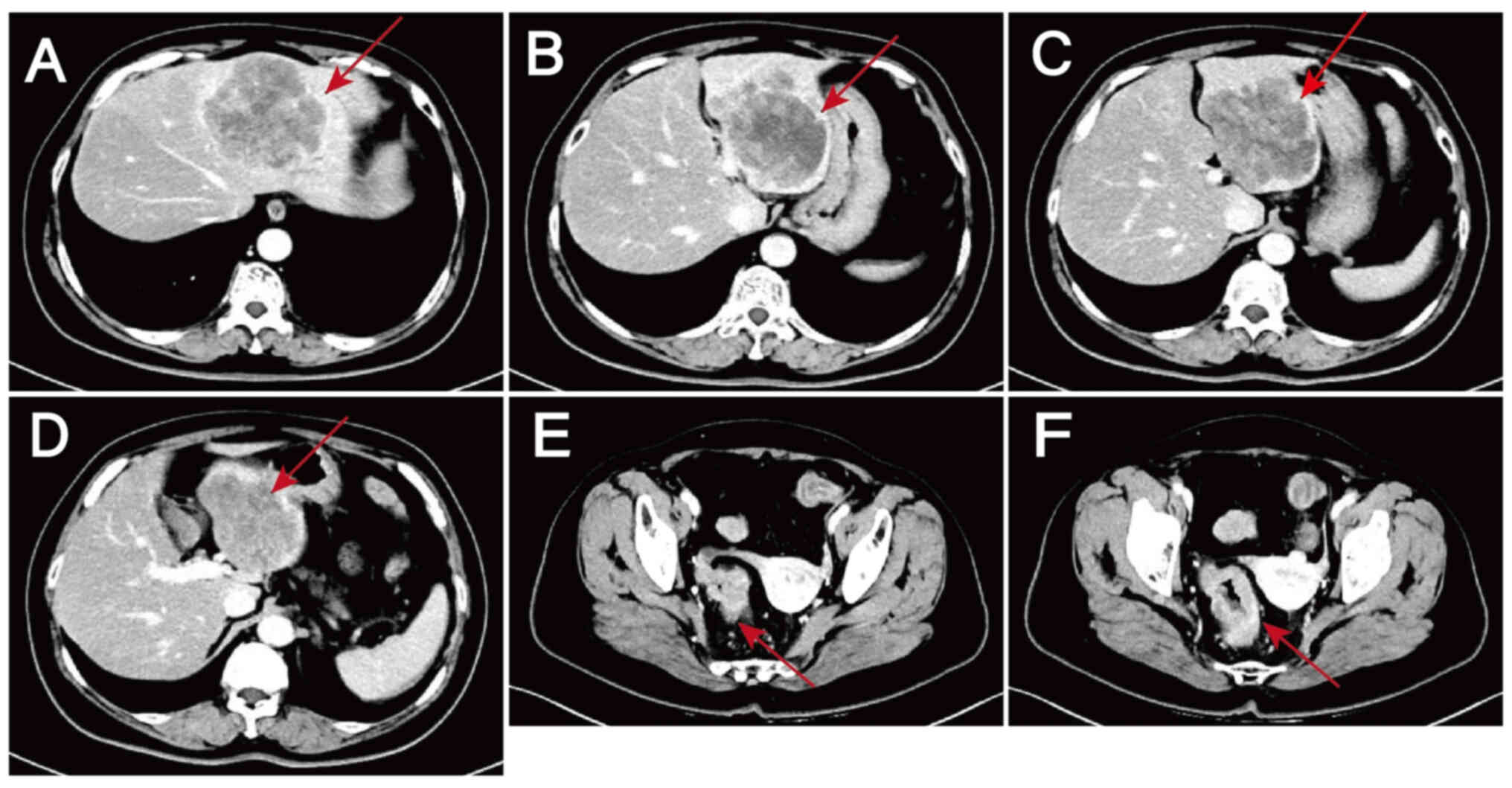 Initial assessment of the lesions by
computed tomography on October 15, 2023. (A-D) Metastatic liver
lesions: Slightly hypodense shadows are visible in the S2, S3 and
S4 segments of the liver, suggestive of metastasis. (E and F) Colon
lesions: Thickening of the sigmoid-rectal wall and enlargement of
the peripheral lymph nodes are indicative of malignancy. Lesions
are indicated by arrows.