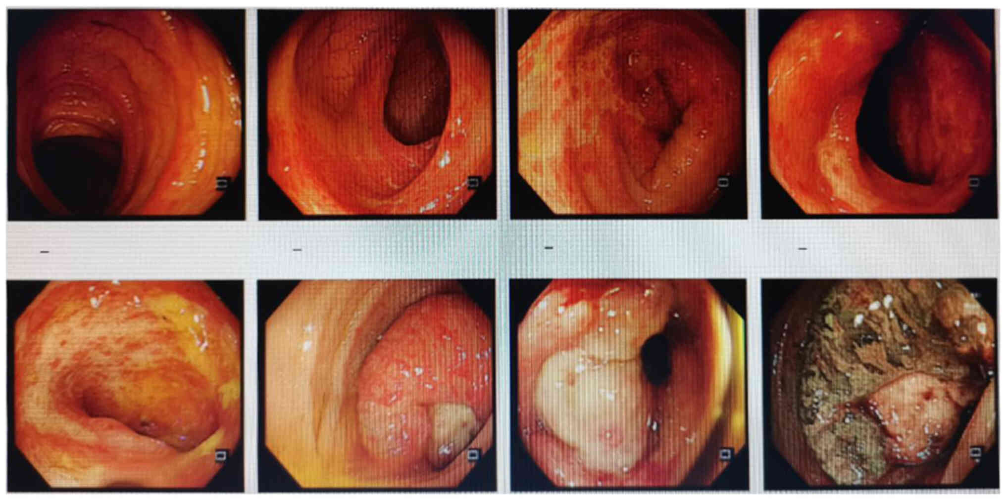 Images captured during colonoscopy
performed on October 17, 2023.