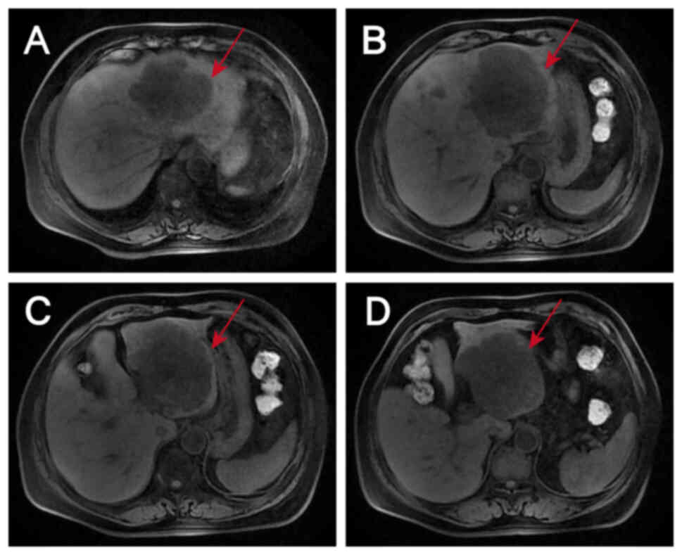Initial assessment of the liver
lesions by magnetic resonance imaging on October 20, 2023. (A-C)
Metastases in the S2, S3 and S4 segments and (D) two enlarged lymph
nodes, one anterior and one posterior to the portal vein are shown.
Lesions are indicated by arrows.