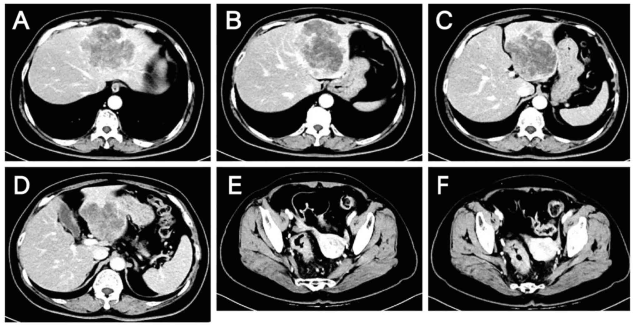 Lesions after 1 cycle of chemotherapy
as evaluated by computed tomography on November 10, 2023. (A-D)
Metastatic liver lesions: No marked change is visible compared with
those on October 15, 2023. (E and F) Colon lesions: Thickening of
the sigmoid-rectal wall is slightly less severe than that on
October 15, 2023, but no changes are evident in the surrounding
enlarged lymph nodes.