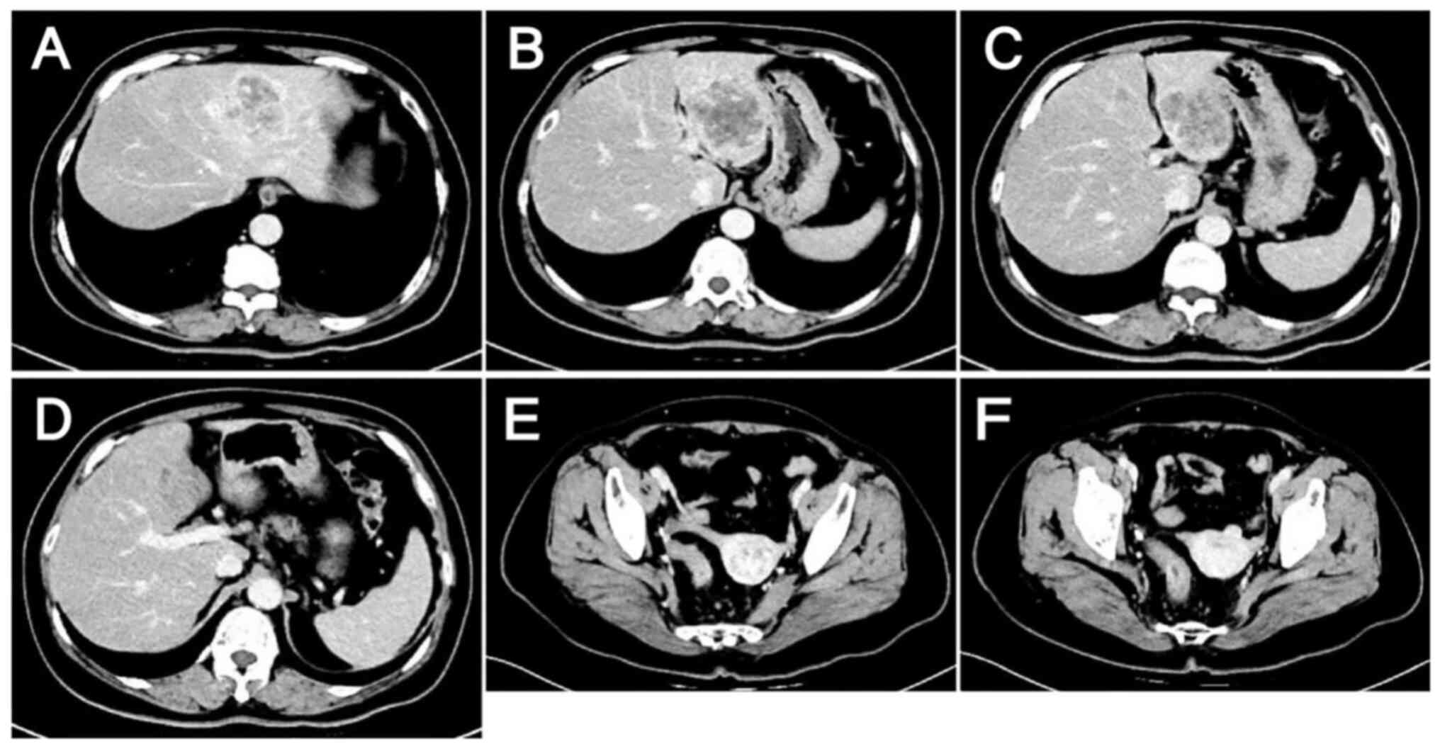 Lesions after 1 cycle of anti-HER2
therapy combined with chemotherapy as evaluated by computed
tomography on December 13, 2023. (A-D) Metastatic liver lesions:
Lesions appear smaller compared with those on November 10, 2023. (E
and F) Colon lesions: Thickening of the sigmoid-rectal wall is
reduced, and the enlarged surrounding lymph nodes are slightly
smaller than they were on November 10, 2023.