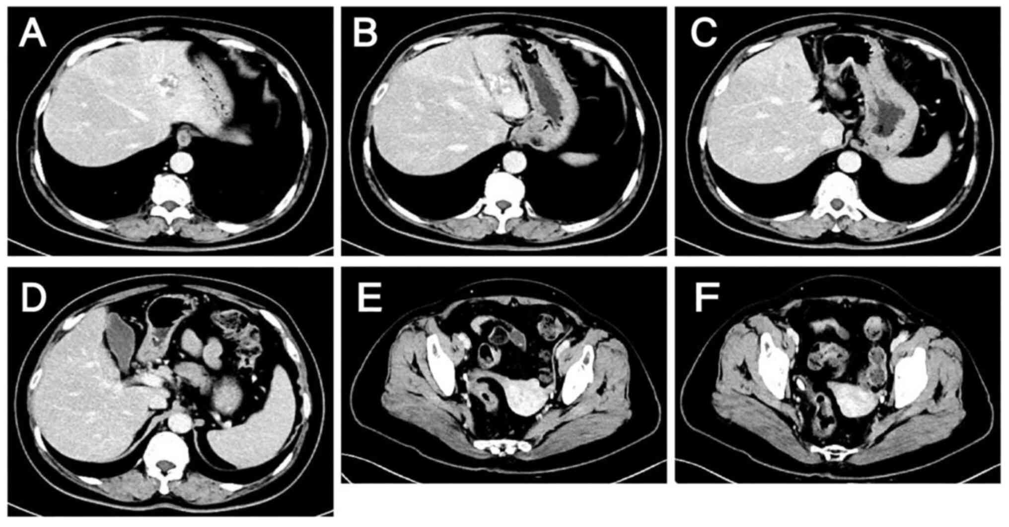 Lesions after 4 cycles of anti-HER2
therapy combined with chemotherapy as evaluated by computed
tomography on February 16, 2024. (A-D) Metastatic liver lesions:
Lesions are smaller compared with those on December 13, 2023. (E
and F) Colon lesions: Thickening of the sigmoid-rectal wall is
reduced and the surrounding lymph nodes are slightly smaller than
they were on December 13, 2023.