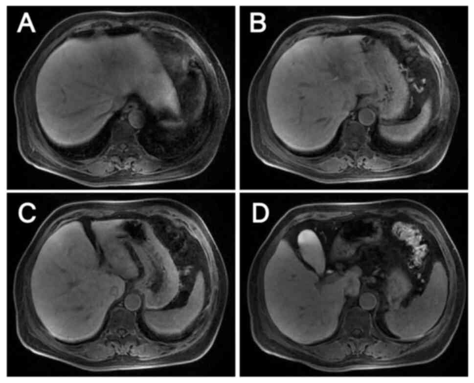 Metastatic liver lesions after 3
cycles of anti-HER2 therapy combined with chemotherapy as evaluated
by magnetic resonance imaging on January 25, 2024. (A-C) Metastases
in the S2, S3 and S4 segments of the liver are clearly reduced in
size compared with those on October 20, 2023. (D) The two lymph
nodes anterior and posterior to the portal vein are also less
enlarged.