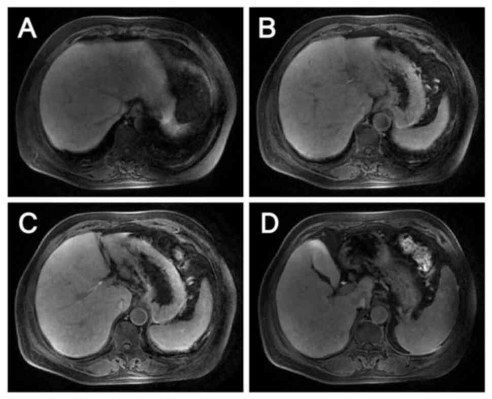 Metastatic liver lesions after 6
cycles of anti-HER2 therapy combined with chemotherapy as assessed
by magnetic resonance imaging on April 10, 2024. When compared with
the images captured on January 25, 2024, (A-C) the larger
metastases in S2, S3 and S4 have decreased in size, while the
smaller metastasis appears unchanged. (D) No changes in the two
enlarged lymph nodes anterior and posterior to the portal vein are
evident.