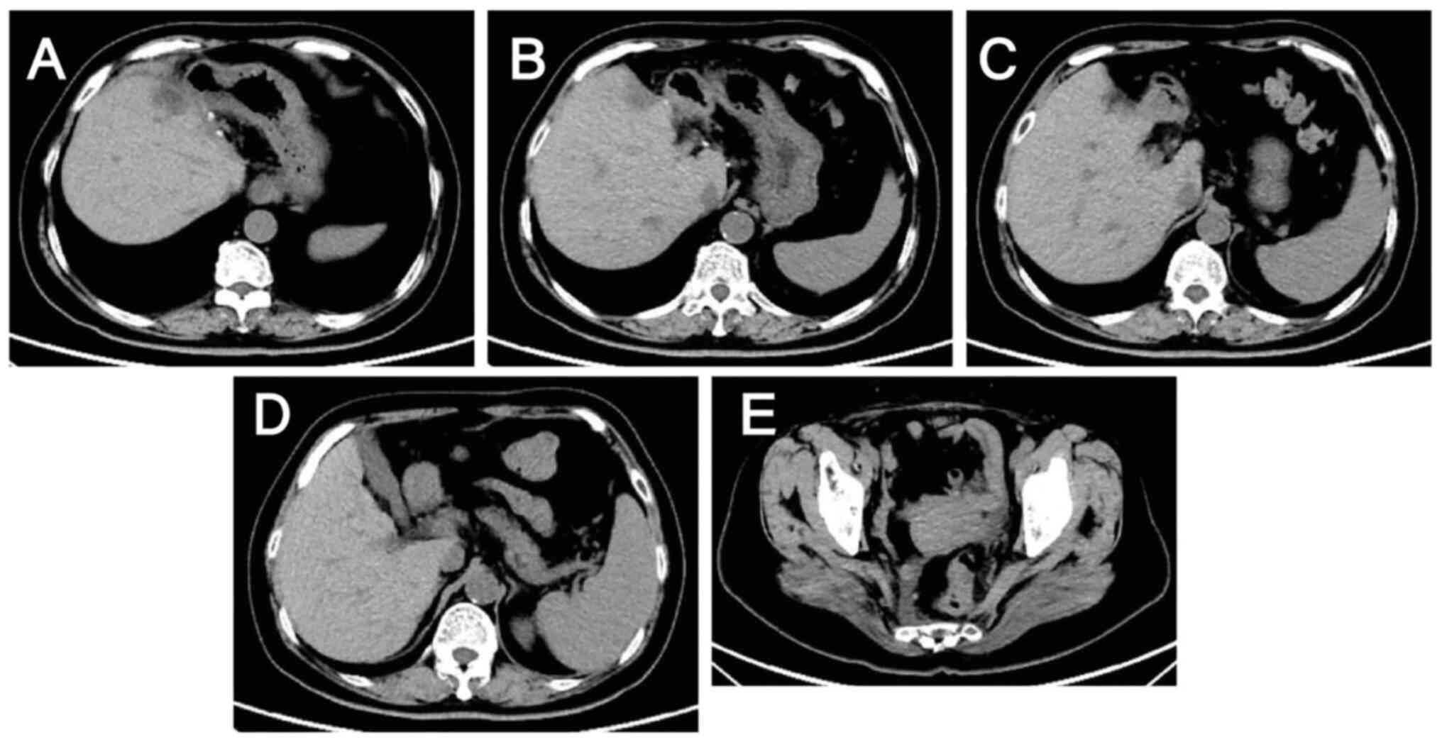 Lesions 3 weeks after surgery as
assessed by computed tomography on May 16, 2024. Sites of excision
of the (A-D) Metastatic liver lesions and (E) primary colon
lesion.