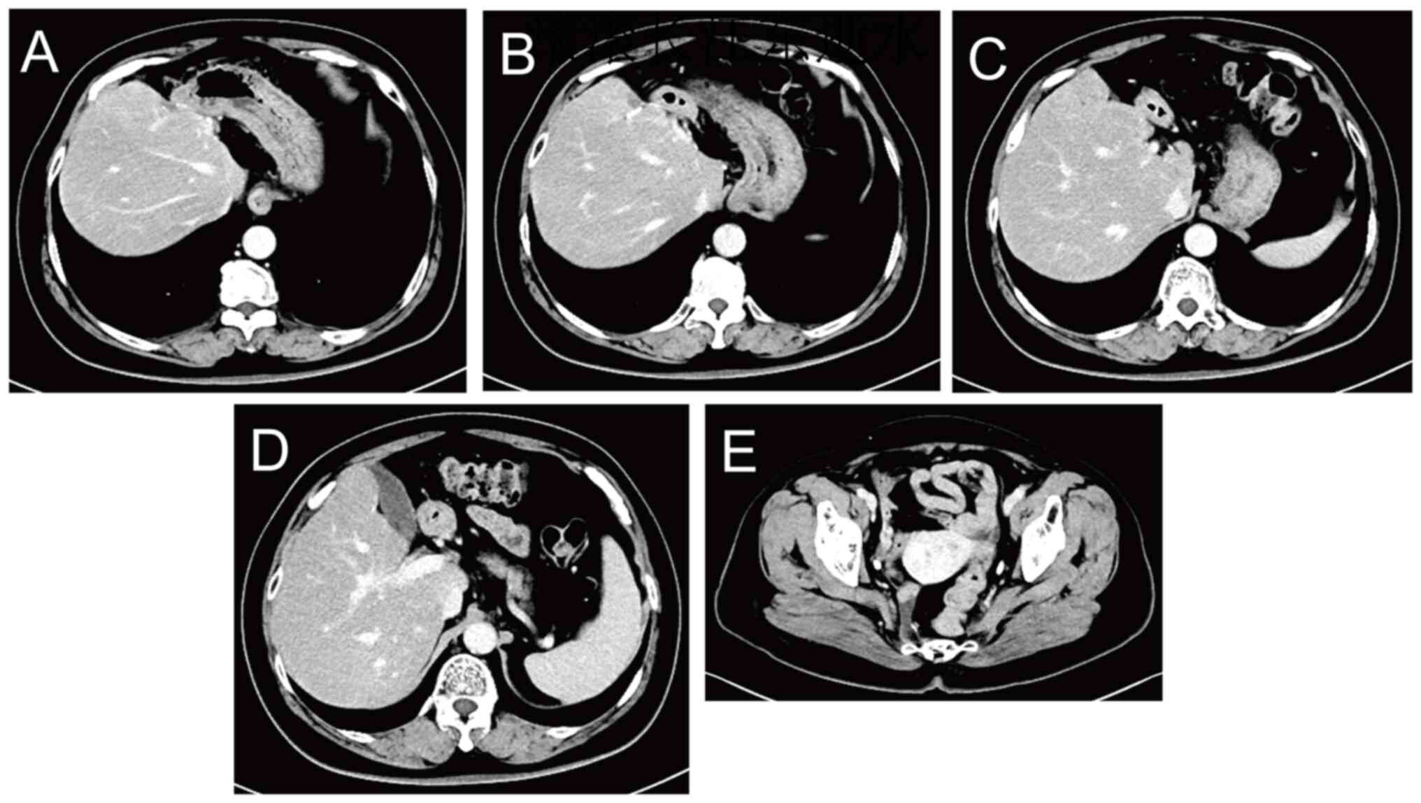 Computed tomography images acquired
on November 25, 2024, 1 year after the initiation of anti-HER2
therapy. Sites of excision of the (A-D) metastatic liver lesions
and (E) the primary colon lesion.