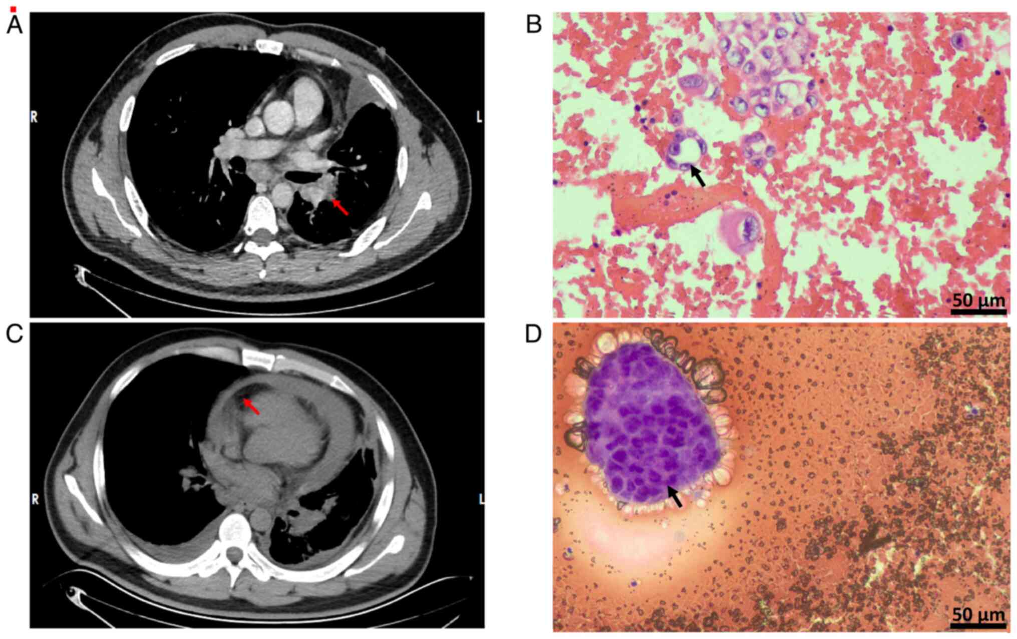Chest CT revealing a lung mass and
pericardial effusion, which was confirmed by H&E staining for
lung adenocarcinoma and pericardial metastases. (A)
Contrast-enhanced chest CT identified a pulmonary mass in the left
upper lobe, indicated by the red arrow, which exhibited
characteristic neoplastic morphology. (B) Analysis via H&E
staining of the pleural effusion confirmed metastatic lung
adenocarcinoma. Tumor cells are indicated by the black arrow
(H&E staining; scale bar, 50 µm). (C) Chest CT demonstrated
pericardial effusion. The red arrow indicates thrombosis of the
splenic artery. (D) H&E staining of the pericardial effusion
also revealed lung adenocarcinoma cells. Tumor cells are indicated
by the black arrow (H&E staining; scale bar, 50 µm).