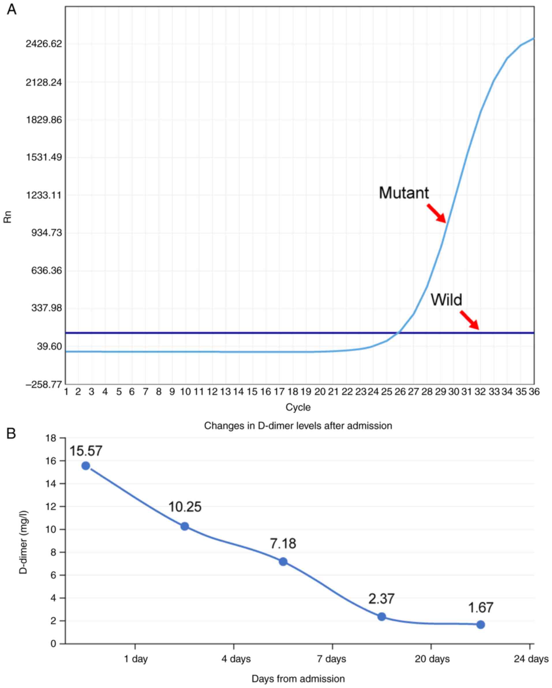 Genetic test results and D-dimer
trend changes. (A) Amplification refractory mutation system-PCR
analysis confirmed a heterozygous activating mutation at exon 21 of
the EGFR gene (c.2573T>G, p.Leu858Arg). The purple horizontal
line represents wild-type; the blue horizontal line represents
mutant-type. (B) Following admission, the D-dimer levels of the
patient exhibited a decreasing trend. Rn, normalized reporter.