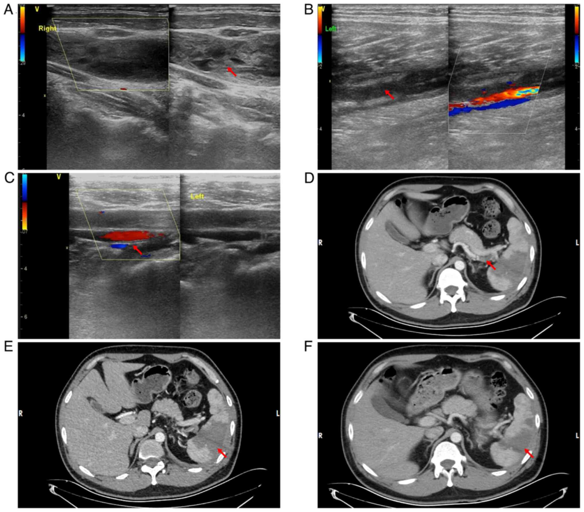 Ultrasound findings indicating
multiple thrombi formation in multiple locations and
contrast-enhanced abdominal CT revealing splenic infarction. A
colored scale is used to indicate the direction and relative
velocity of the blood flow signal, with red indicating blood flow
towards the ultrasound probe and blue indicating blood flow away
from the ultrasound probe. (A) Color Doppler ultrasound indicated
thrombosis in the right internal jugular vein. The red arrow
indicates a thrombosis. (B) Color Doppler ultrasound demonstrated
thrombosis in the left popliteal vein. The red arrow indicates a
thrombosis. (C) Color Doppler ultrasound indicated thrombosis in
the left peroneal vein. The red arrow indicates a thrombosis. (D)
Contrast-enhanced abdominal CT demonstrated splenic artery
thrombosis and the red arrow indicates the thrombus. (E)
Contrast-enhanced CT demonstrated wedge-shaped hypodensity in the
splenic parenchyma, indicated by the red arrow, consistent with
ischemic infarction. No evidence of liquefactive necrosis or
abscess formation was observed. (F) Following a standard
anticoagulation regimen (8,000 IU subcutaneously every 12 h), at 1
month post-treatment, contrast-enhanced CT revealed a slight
reduction in the extent of the splenic infarction. The red arrow
indicates the infarcted spleen.
