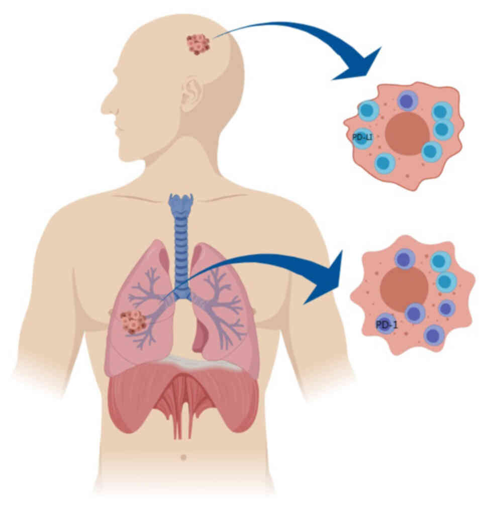 Differences in the immune
microenvironment between intracranial and extracranial brain
metastases. PD-1, programmed cell death protein 1; PD-L1,
programmed cell death protein ligand 1.