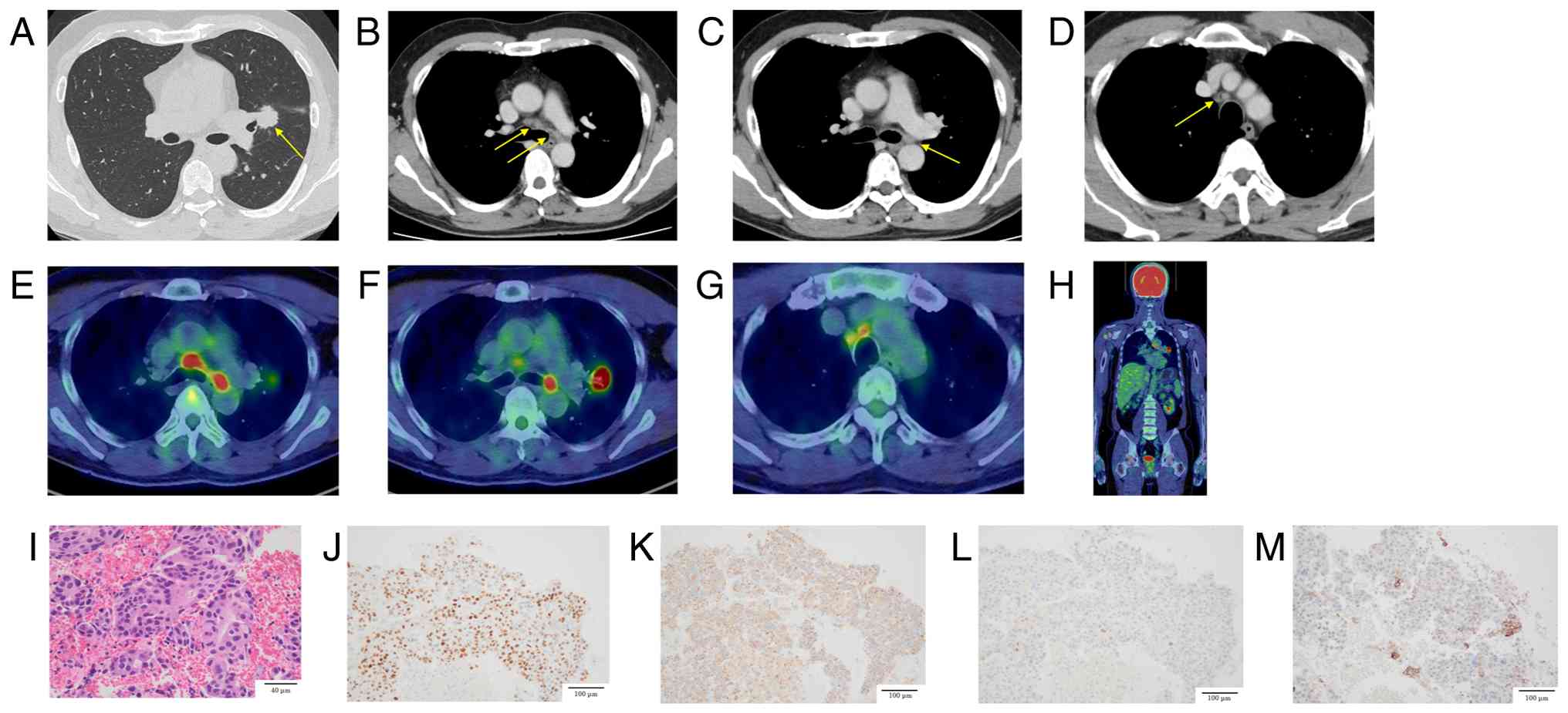 (A) Chest CT revealed a 23-mm
irregular nodular lesion with spiculated margins in the left upper
lobe hilum, suspected to be the primary tumor. (B) Enlarged right
lower paratracheal and left lower paratracheal lymph nodes. (C)
Enlarged left hilar lymph node. (D) Enlarged right upper
paratracheal lymph node. (E) 18F-FDG positron emission
tomography/CT showed high FDG uptake in the right lower
paratracheal lymph node (SUVmax, 7.71) and the left lower
paratracheal lymph node (SUVmax, 7.83). (F) High FDG uptake in the
irregular left upper lobe mass near the hilum, suspected to be the
primary tumor (SUVmax, 16.73), and in the left hilar lymph node
(SUVmax, 9.39). (G) High FDG uptake in the right upper paratracheal
lymph node (SUVmax, 5.44). (H) No abnormal FDG uptake suggestive of
other distant metastases was observed. (I) Pathological findings
revealed atypical cells with hyperchromatic nuclei proliferating
while exhibiting a poorly formed glandular structure, indicative of
adenocarcinoma. (J) Dual immunostaining: TTF-1 (nucleus) positive,
CK5/6 (cytoplasm) negative. (K) Dual immunostaining: Napsin A
(cytoplasm) positive, p40 (nucleus) negative. (L) Hepatocyte
nuclear factor 4 alpha was negative. (M) Programmed death-ligand 1
immunostaining revealed a tumor proportion score of less than 1%.
Arrows indicate the primary tumor in (A), the right and left lower
paratracheal nodes in (B), the left hilar node in (C), and the
right upper paratracheal node in (D). 18F-FGD,
18F-fluorodeoxyglucose; CT, computed tomography; SUVmax,
standardized uptake value.
