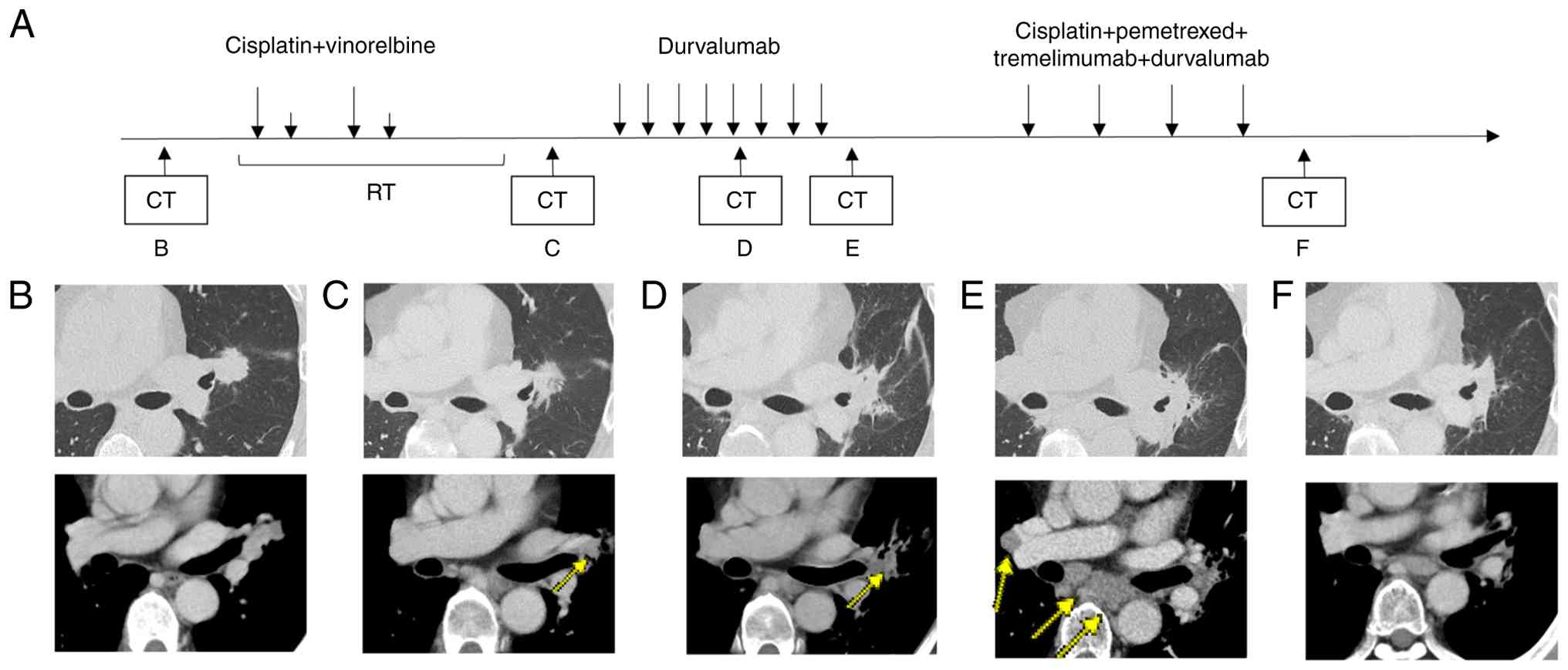 (A) Imaging and therapeutic response
before and during treatment. (B) Prior to treatment, an irregular
mass was observed near the hilum of the left upper lobe,
accompanied by enlargement of the mediastinal and left hilar lymph
nodes. (C) Chest CT after concurrent chemoradiotherapy, showing a
partial response; the arrow indicates the primary lesion. (D) CT
after 5 cycles of durvalumab, showing a partial response; the arrow
indicates the primary lesion. (E) CT after 8 cycles of durvalumab,
showing progressive disease; the arrows indicate metastatic lesions
in the right hilar and mediastinal lymph nodes. (F) CT after 4
cycles of cisplatin plus pemetrexed plus tremelimumab plus
durvalumab, showing stable disease. CCRT, concurrent
chemoradiotherapy; CT, computed tomography; PD, progressive
disease; PR, partial response; SD, stable disease.