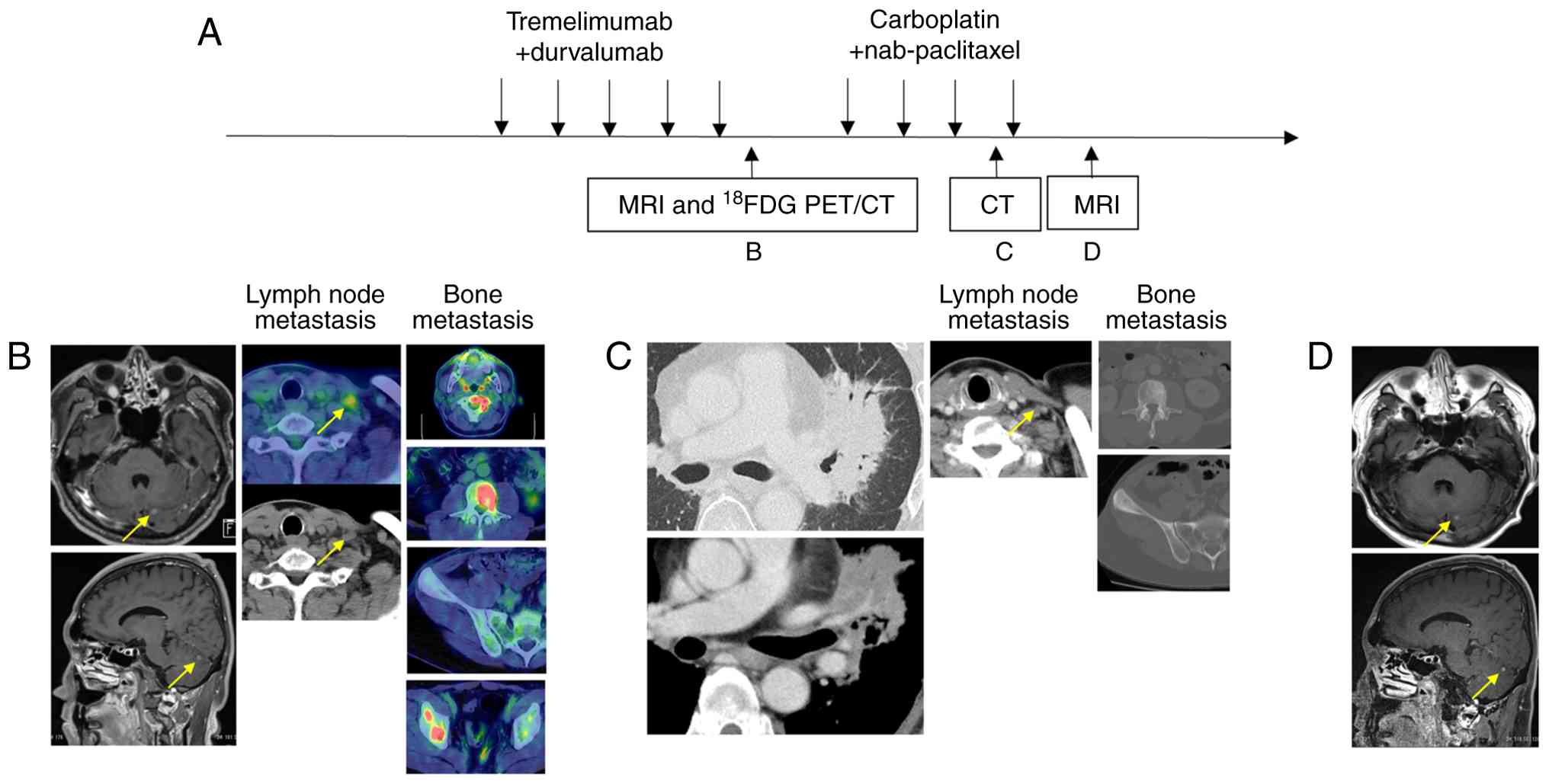 (A) Imaging and therapeutic response
before and during treatment. (B) MRI and 18F-FDG PET/CT
after 5 cycles of maintenance therapy with durvalumab + pemetrexed,
showing progressive disease; the arrows indicate cerebellar
metastasis and supraclavicular lymph node metastasis, respectively.
(C) CT after 3 cycles of CBDCA plus nab-PTX, showing stable
disease; the arrow indicates supraclavicular lymph node metastasis.
(D) MRI after 3 cycles of CBDCA plus nab-PTX, showing stable
disease; the arrows indicate cerebellar metastasis.
18F-FDG PET, 18F-fluorodeoxyglucose positron
emission tomography; CBDCA, carboplatin; CT, computed tomography;
nab-PTX, nab-paclitaxel; PD, progressive disease; SD, stable
disease.