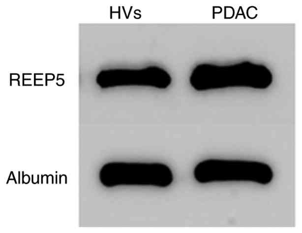 REEP5 protein is detected in total
serum. Representative western blot of REEP5 and albumin in total
serum (5.0 µg protein loaded per column) of patients with PDAC and
HVs. REEP5, receptor expression-enhancing protein 5; HVs, healthy
volunteers; PDAC, pancreatic ductal adenocarcinoma.