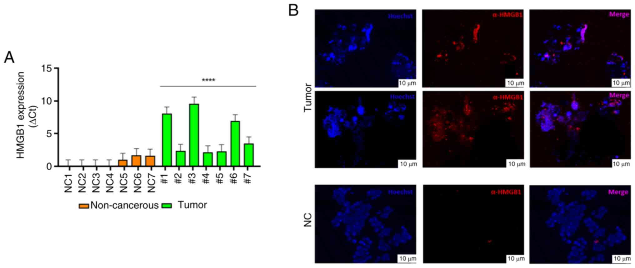 RT-qPCR and immunofluorescence. (A)
RT-qPCR analysis of HMGB1 in two groups of PDOs: The first one
derived from fibroadenoma samples considered as non-cancerous
tissue sample (NC01-NC07) and the second one derived from tumor
tissues (1–7). Results were normalized to β-actin mRNA
and analyzed by the 2−ΔΔCq method. One-way ANOVA test
followed by Tukey's test were used for statistical analysis.
****P<0.001. (B) Representative images of HMGB1 localization in
tumor and non-cancerous ex vivo patient-derived organoids.
Scale bar, 10 µm. RT-qPCR, reverse transcription-quantitative PCR;
HMGB1, High mobility group box 1; NC, negative control.