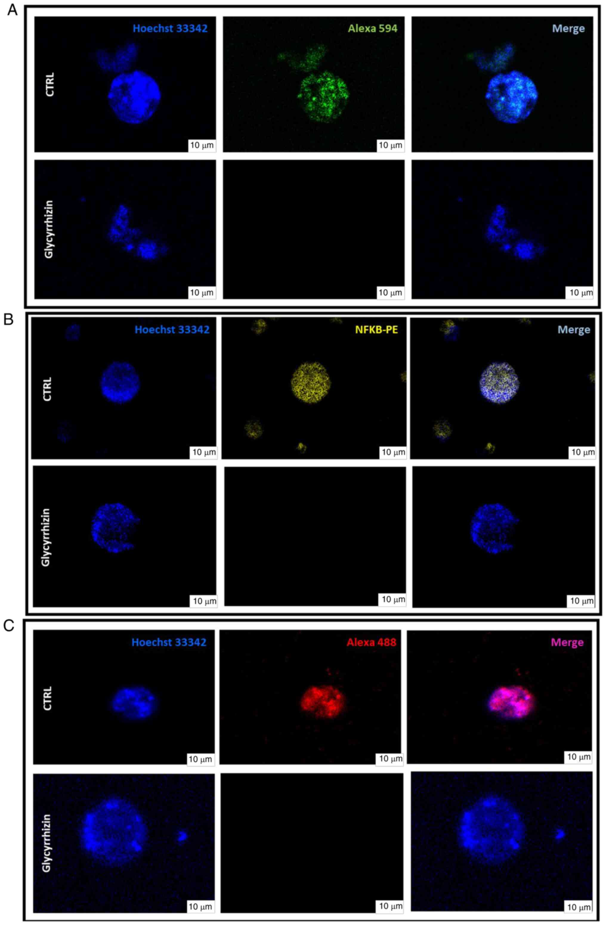 Representative images of our target
molecules through immunofluorescence analysis. (A-C) Localization
of (A) β-Catenin, (B) NF-κB and (C) α-HMGB1 in tumor ex vivo
PDOs before (CTRL) and after treatment with 50 µM of Glycyrrhizin,
direct HMGB1 inhibitor. Maximal projection images of PDO incubated
with β-Catenin (green signal), NF-κB (yellow signal) and α-HMGB1
(red spots). Cell nuclei were stained with Hoechst 33342 (blue
signal). Scale bar, 10 µm. The disappearance of (A) β-Catenin and
(B) NF-κB signals after treatment is shown; this effect is driven
by HMGB1, which is completely inactivated by (C) Glycyrrhizin. HMGB
1, High mobility group box 1; CTRL, untreated control.